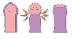 包茎不及时治疗的后果你不得不重视