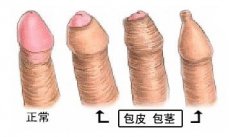 包皮过长不治疗行吗?不做手术的危害你可能不知道