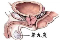 睾丸炎危害大,千万不要忽视治疗！