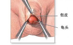 汉中割包皮哪家医院更好-包皮手术后要注意什么