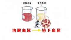 小便里面为什么会有血,血尿原因介绍