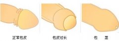 怎样才算是包皮过长