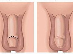 你是包皮长还是包皮过长